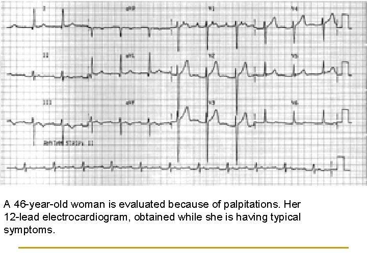 A 46 -year-old woman is evaluated because of palpitations. Her 12 -lead electrocardiogram, obtained