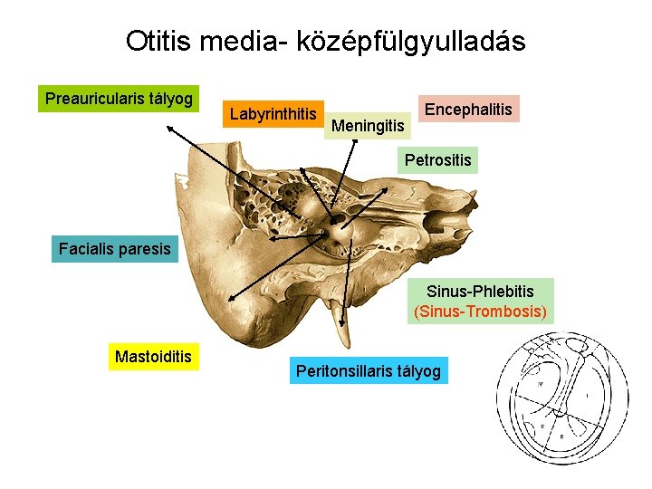 Otitis media- középfülgyulladás Preauricularis tályog Labyrinthitis Meningitis Encephalitis Petrositis Facialis paresis Sinus-Phlebitis (Sinus-Trombosis) Mastoiditis