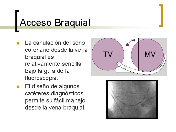 Acceso Braquial n n La canulación del seno coronario desde la vena braquial es