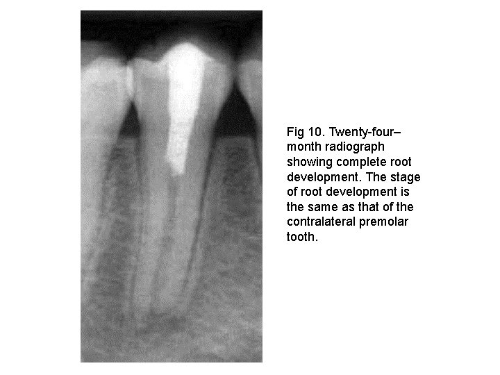 Fig 10. Twenty-four– month radiograph showing complete root development. The stage of root development