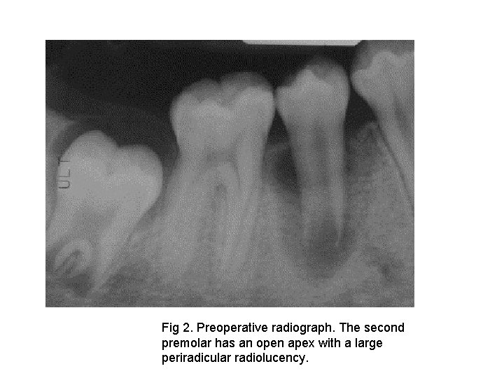 Fig 2. Preoperative radiograph. The second premolar has an open apex with a large