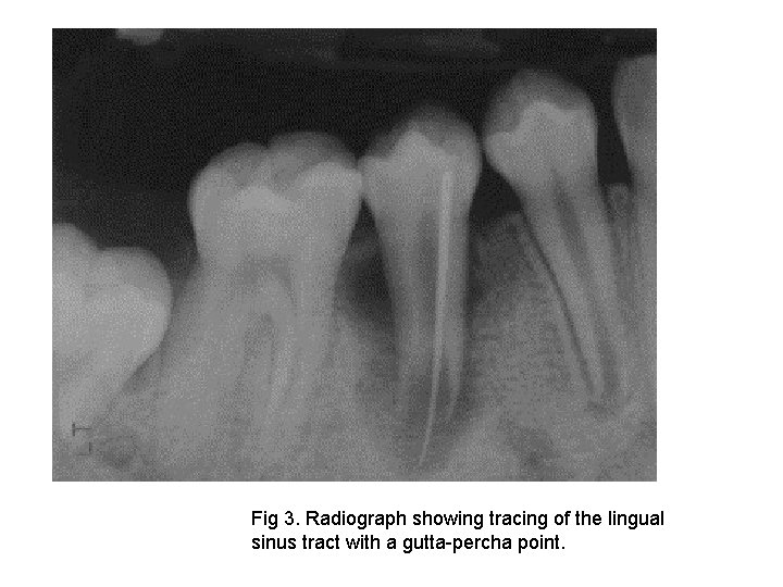 Fig 3. Radiograph showing tracing of the lingual sinus tract with a gutta-percha point.