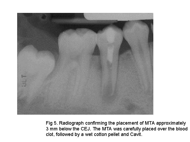 Fig 5. Radiograph confirming the placement of MTA approximately 3 mm below the CEJ.