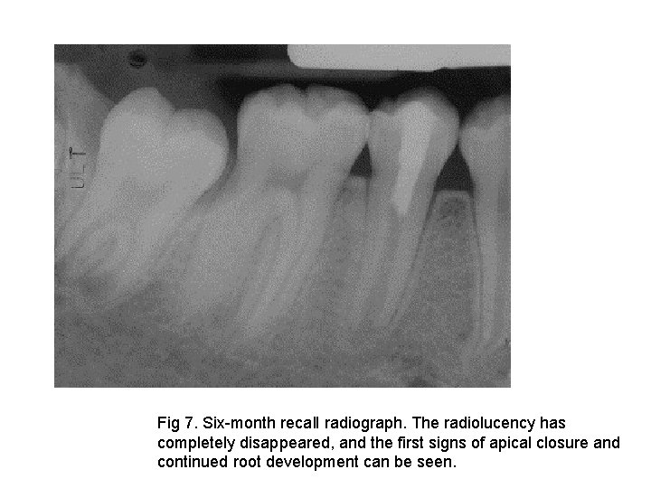 Fig 7. Six-month recall radiograph. The radiolucency has completely disappeared, and the first signs