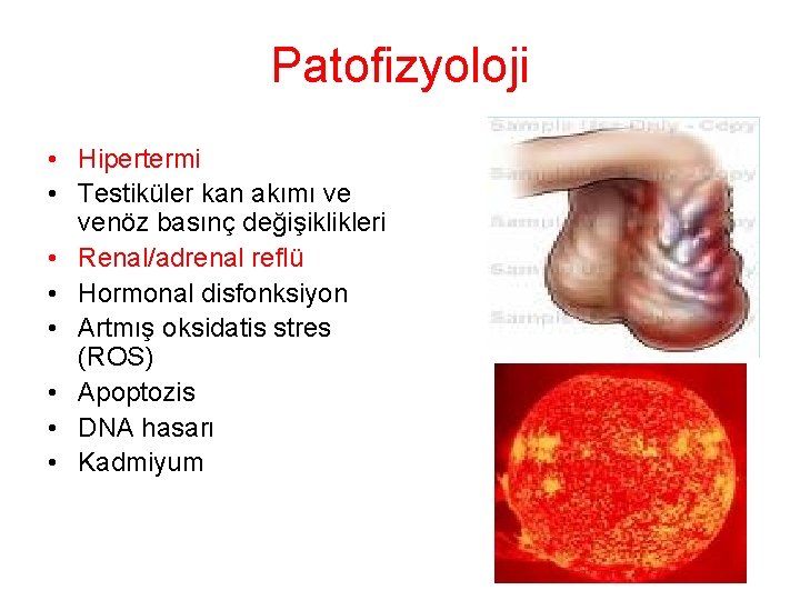 Patofizyoloji • Hipertermi • Testiküler kan akımı ve venöz basınç değişiklikleri • Renal/adrenal reflü