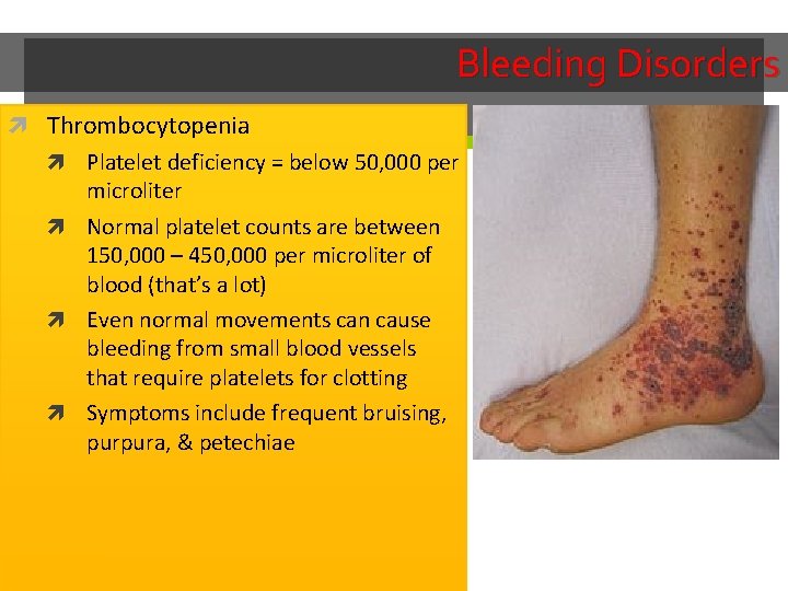 Bleeding Disorders Thrombocytopenia Platelet deficiency = below 50, 000 per microliter Normal platelet counts