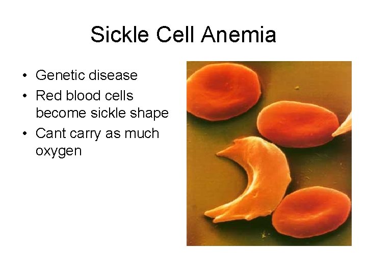 Sickle Cell Anemia • Genetic disease • Red blood cells become sickle shape •