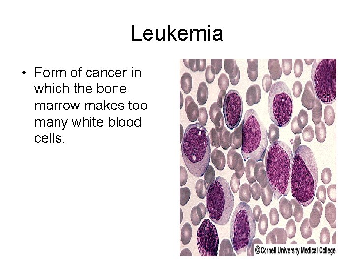 Leukemia • Form of cancer in which the bone marrow makes too many white