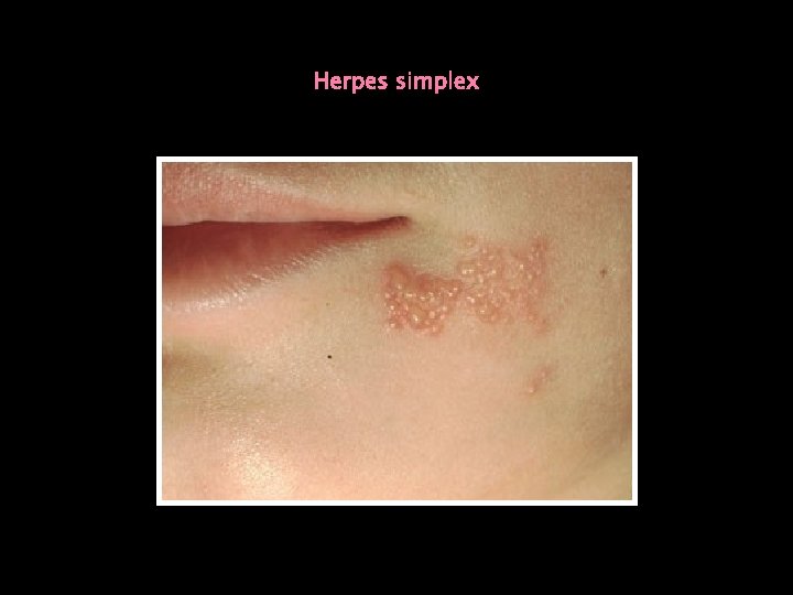 Herpes simplex 