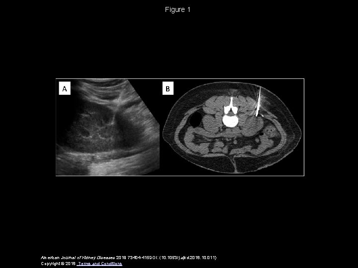 Figure 1 American Journal of Kidney Diseases 2019 73404 -415 DOI: (10. 1053/j. ajkd.