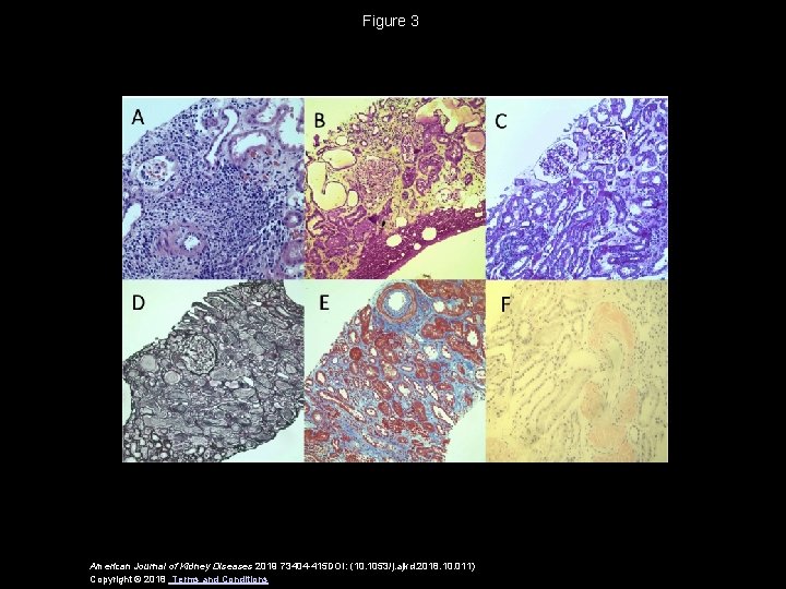 Figure 3 American Journal of Kidney Diseases 2019 73404 -415 DOI: (10. 1053/j. ajkd.