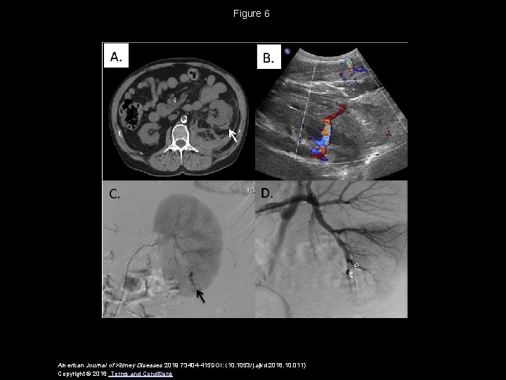 Figure 6 American Journal of Kidney Diseases 2019 73404 -415 DOI: (10. 1053/j. ajkd.