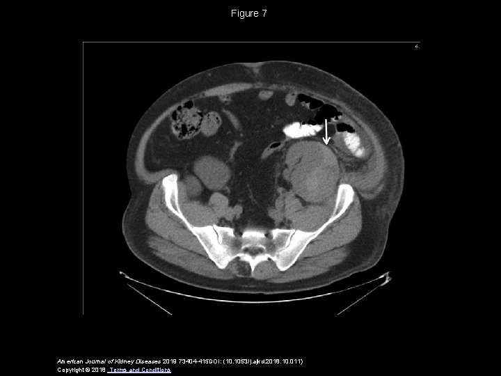 Figure 7 American Journal of Kidney Diseases 2019 73404 -415 DOI: (10. 1053/j. ajkd.