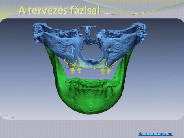 A tervezés fázisai dentarttechnik. hu 