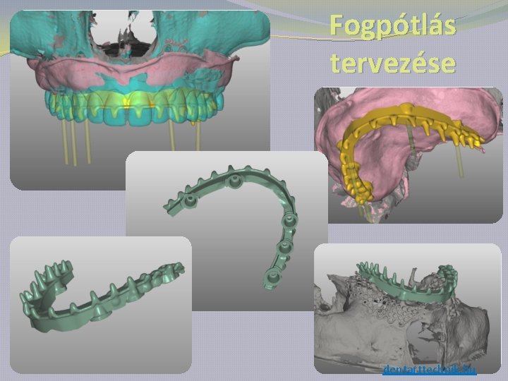 Fogpótlás tervezése dentarttechnik. hu 