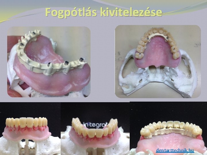 Fogpótlás kivitelezése dentarttechnik. hu 