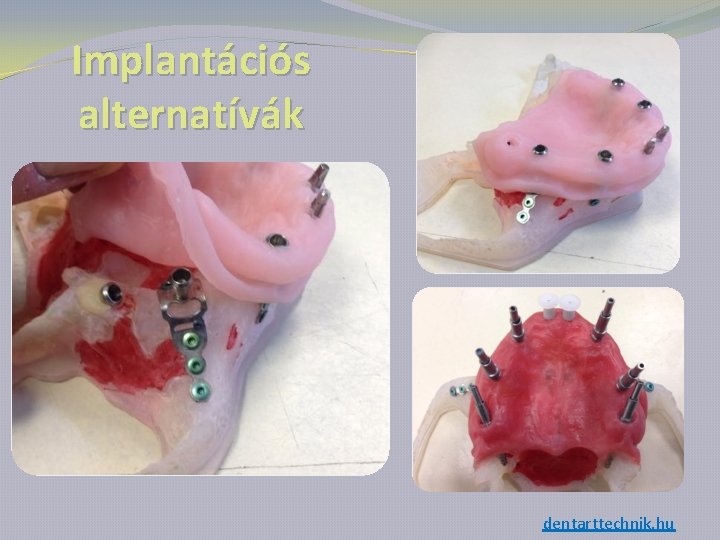 Implantációs alternatívák dentarttechnik. hu 