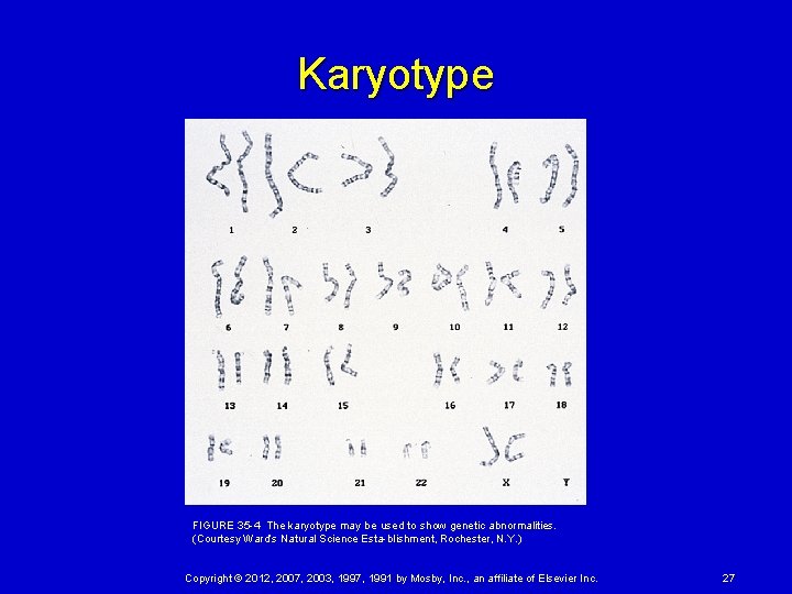 Karyotype FIGURE 35 4 The karyotype may be used to show genetic abnormalities. (Courtesy Ward’s