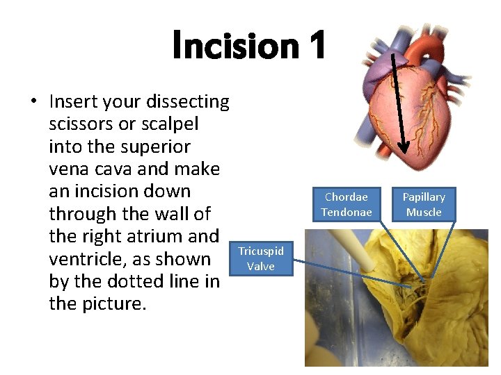 Incision 1 • Insert your dissecting scissors or scalpel into the superior vena cava