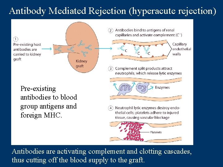 Antibody Mediated Rejection (hyperacute rejection) Pre-existing antibodies to blood group antigens and foreign MHC.