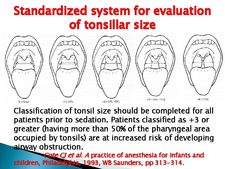 Standardized system for evaluation of tonsillar size Classification of tonsil size should be completed