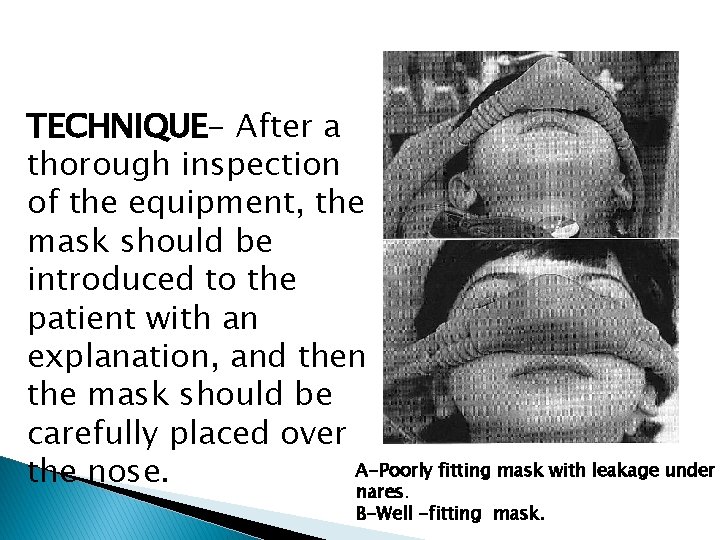 TECHNIQUE- After a thorough inspection of the equipment, the mask should be introduced to