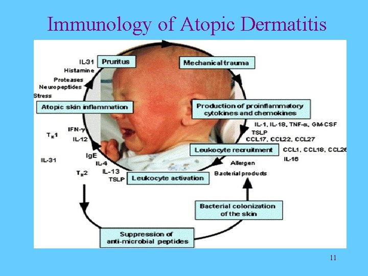 Immunology of Atopic Dermatitis 11 