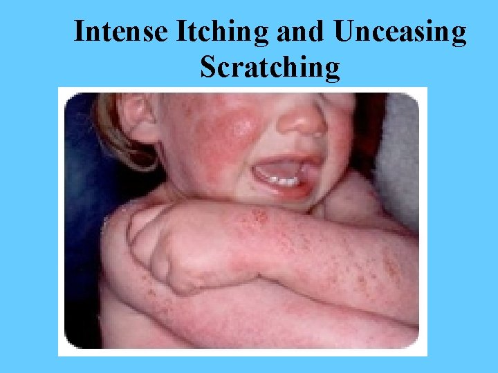 Intense Itching and Unceasing Scratching 