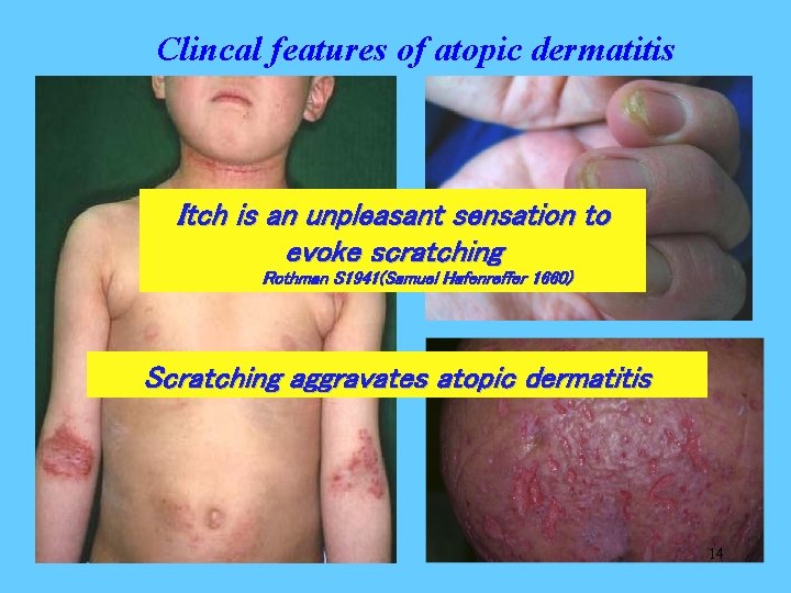 Clincal features of atopic dermatitis Itch is an unpleasant sensation to evoke scratching Rothman