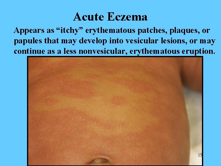 Acute Eczema Appears as “itchy” erythematous patches, plaques, or papules that may develop into