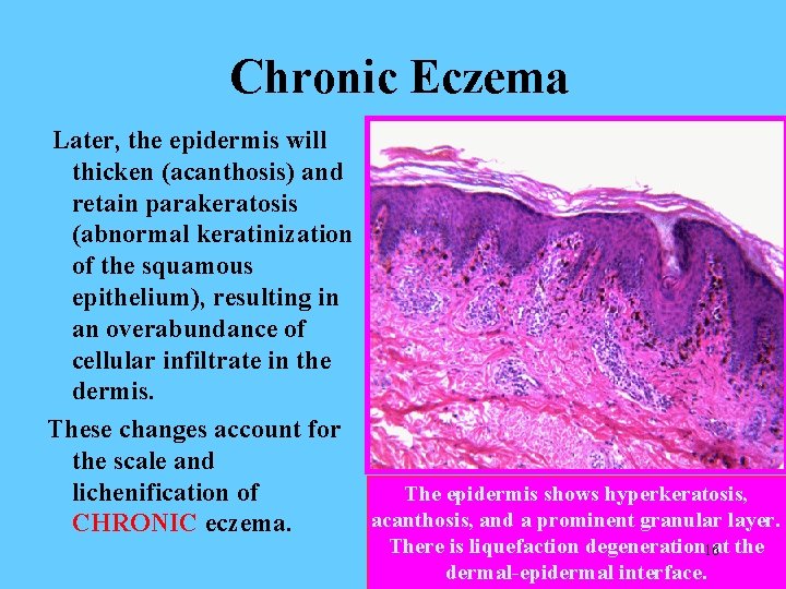 Chronic Eczema Later, the epidermis will thicken (acanthosis) and retain parakeratosis (abnormal keratinization of