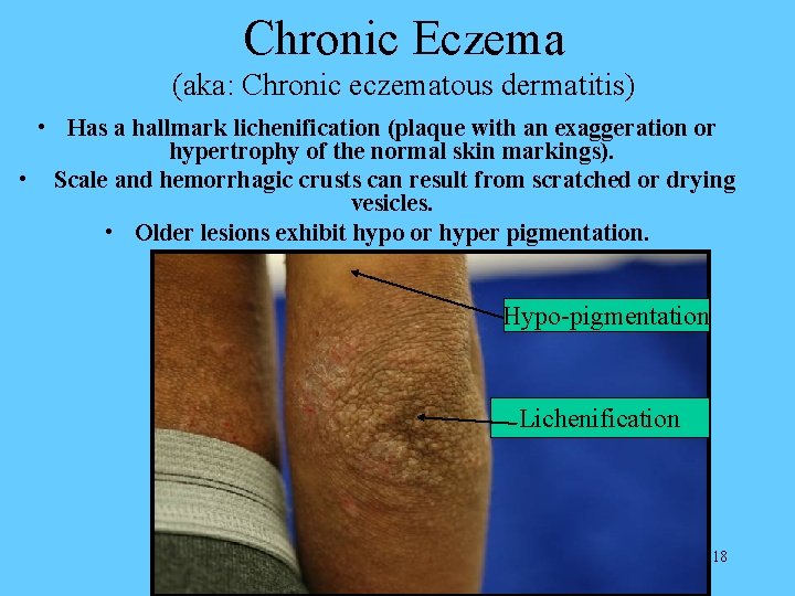 Chronic Eczema (aka: Chronic eczematous dermatitis) • Has a hallmark lichenification (plaque with an