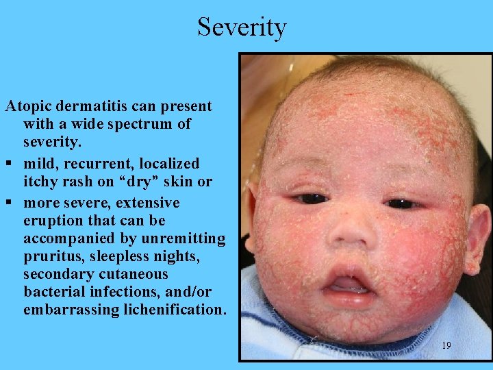 Severity Atopic dermatitis can present with a wide spectrum of severity. § mild, recurrent,