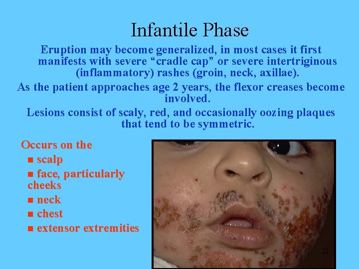 Infantile Phase Eruption may become generalized, in most cases it first manifests with severe