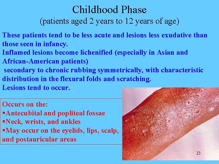 Childhood Phase (patients aged 2 years to 12 years of age) These patients tend