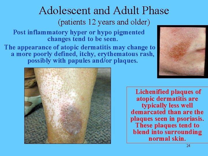 Adolescent and Adult Phase (patients 12 years and older) Post inflammatory hyper or hypo