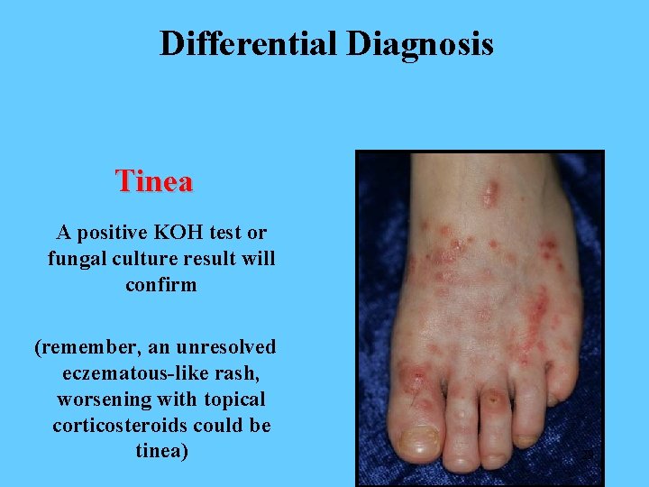 Differential Diagnosis Tinea A positive KOH test or fungal culture result will confirm (remember,