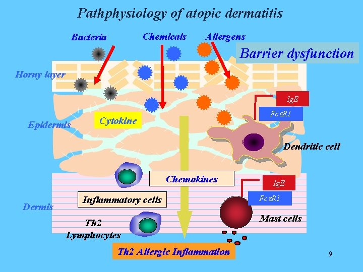 Pathphysiology of atopic dermatitis Chemicals Bacteria Allergens Barrier dysfunction Horny layer Ig. E Epidermis