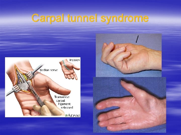 Carpal tunnel syndrome 