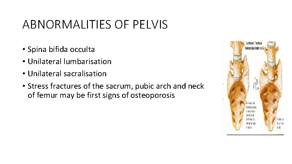 ABNORMALITIES OF PELVIS • Spina bifida occulta • Unilateral lumbarisation • Unilateral sacralisation •