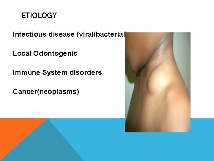 ETIOLOGY Infectious disease (viral/bacterial) Local Odontogenic Immune System disorders Cancer(neoplasms) 