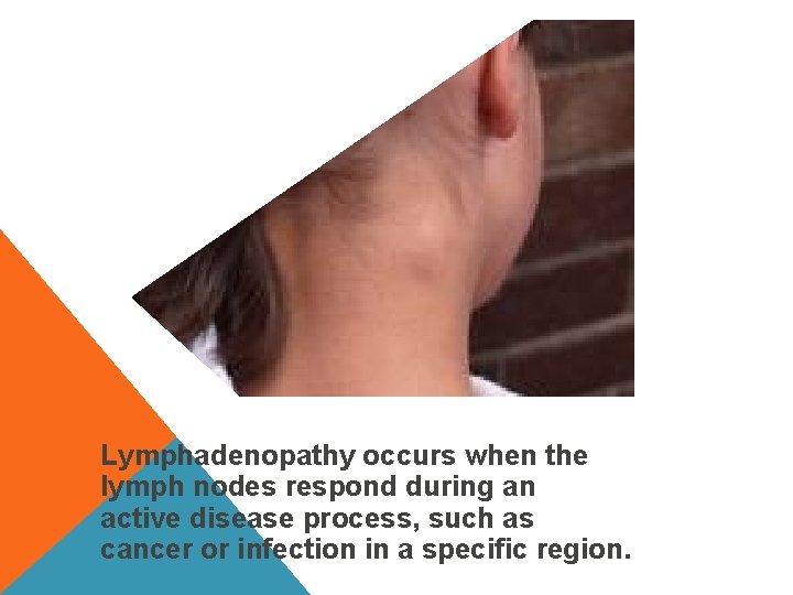 Lymphadenopathy occurs when the lymph nodes respond during an active disease process, such as