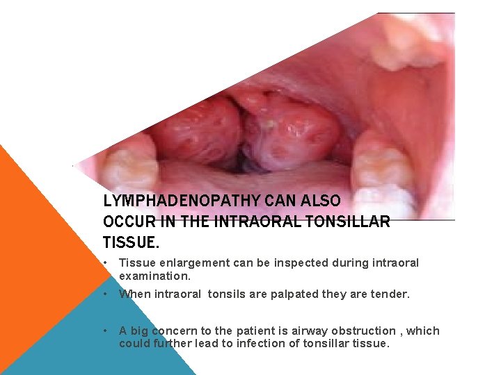 LYMPHADENOPATHY CAN ALSO OCCUR IN THE INTRAORAL TONSILLAR TISSUE. • Tissue enlargement can be