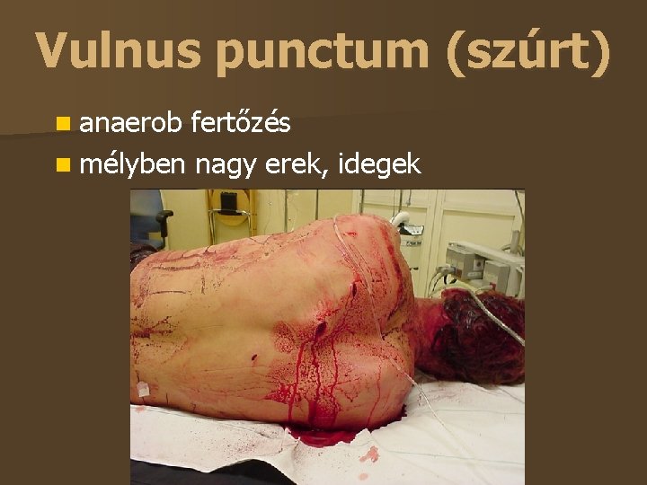 Vulnus punctum (szúrt) anaerob fertőzés mélyben nagy erek, idegek 