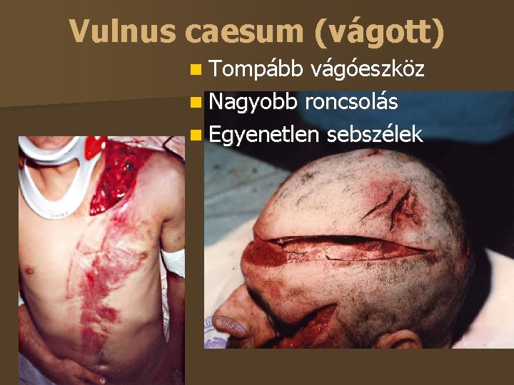 Vulnus caesum (vágott) Tompább vágóeszköz Nagyobb roncsolás Egyenetlen sebszélek 