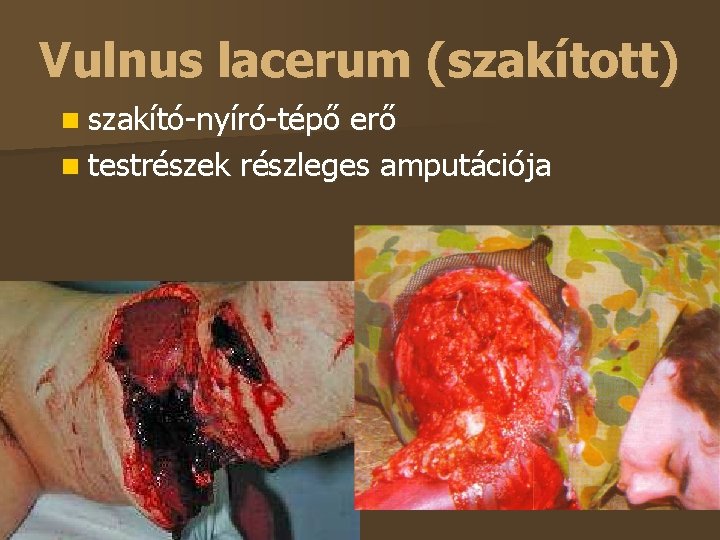 Vulnus lacerum (szakított) szakító-nyíró-tépő erő testrészek részleges amputációja 