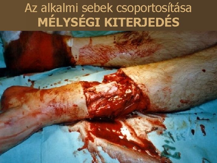 Az alkalmi sebek csoportosítása MÉLYSÉGI KITERJEDÉS szerint I. Felületes § epidermis § dermis a