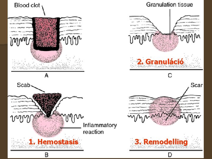 2. Granuláció 1. Hemostasis 3. Remodelling 