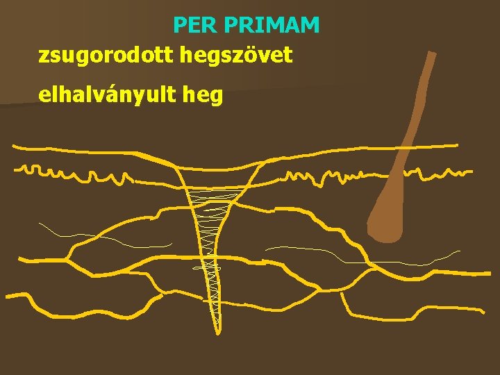 PER PRIMAM zsugorodott hegszövet elhalványult heg 