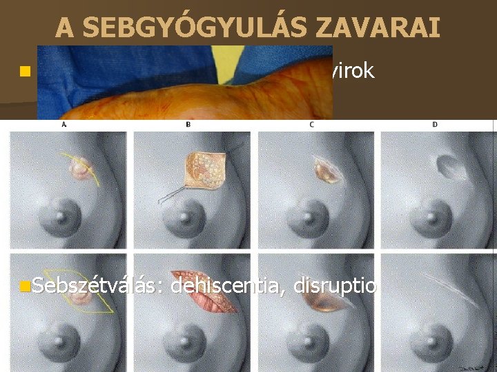 A SEBGYÓGYULÁS ZAVARAI Seroma: sebüregben savó, nyirok – leszívás, kompresszió Haematoma: vérzéscsillapítás, drainage, antikoaguláció